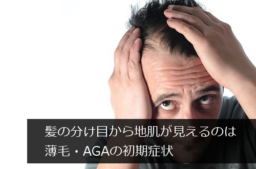 AGAの初期症状