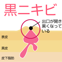 黒ニキビの特徴