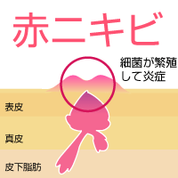 赤ニキビの特徴