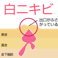 白ニキビの特徴