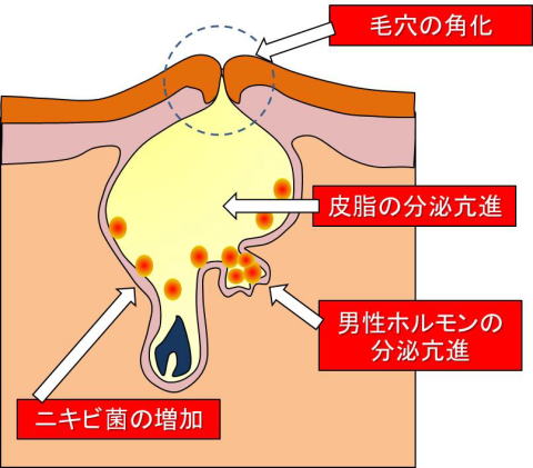 医学的にニキビとは何か?