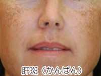 肝斑の症状
