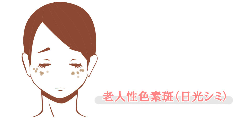 老人性色素斑とは?