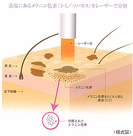 医療レーザー治療