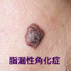 脂漏性角化症の症状