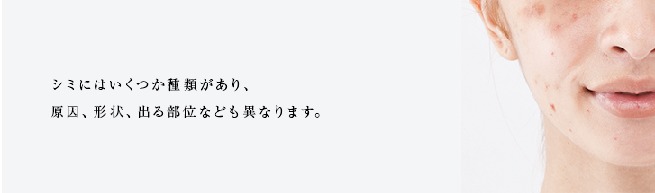 シミの種類やメカニズムを知ろう