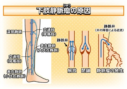 下肢静脈瘤