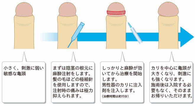 注射や手術でペニス増大