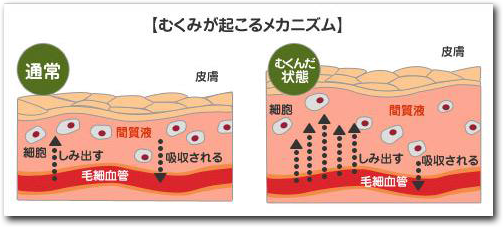 むくみのメカニズム