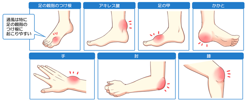 痛風の痛みと苦しみ